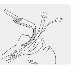 麻醉窥视片气道插管运行模式示意图